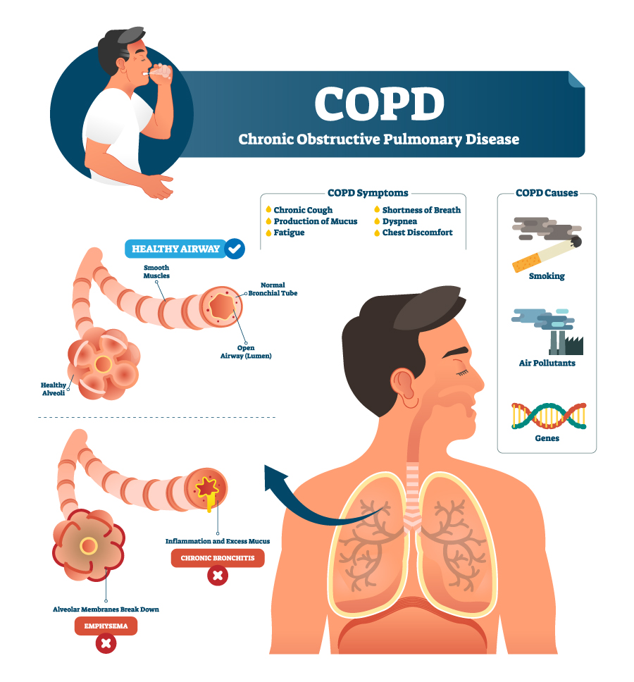 Diagnosing the Rural COPD Patient: Ask About Symptoms, Use Spirometry ...